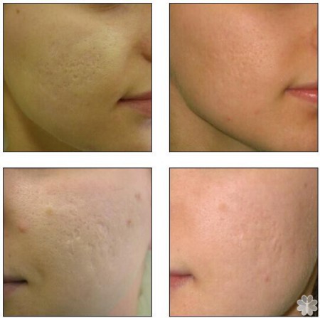 Kolagénová terapia